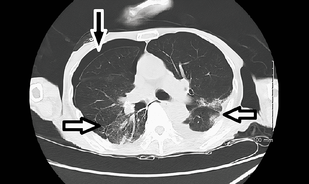 CT-scan-of-the-chest-without-intravenous-contrast-obtained-prior-to-patient's-transfer-to-another-acute-care-facility-showed-moderate-right-sided-pneumothorax-(black-arrow)-with-bilateral-ground-glass-opacities-indicative-of-infection/pneumonia-(white-arrows).