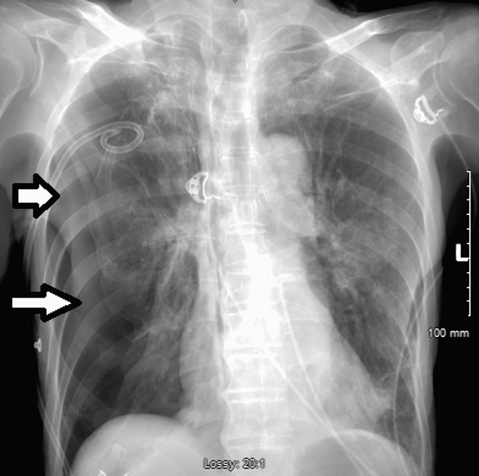 Chest-X-ray-suggestive-of-marked-right-sided-pneumothorax-(white-arrows).