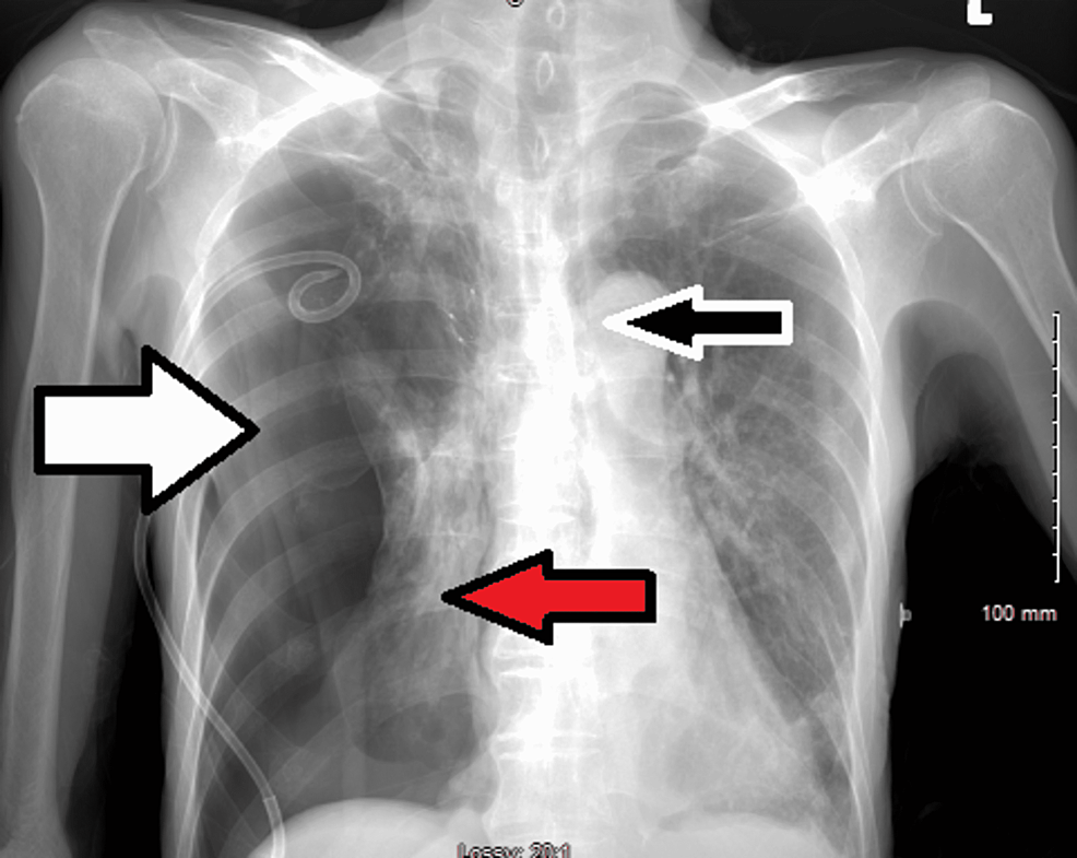 Chest-X-ray-showed-pneumothorax-(white-arrow)-with-worsening-atelectasis-in-the-right-lung-(red-arrow)-and-mild-leftward-shift-in-the-midline-(black-arrow).