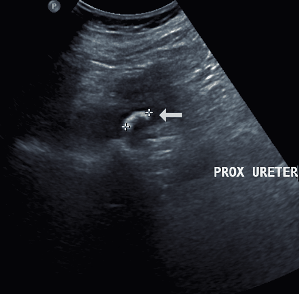 Ultrasonography-of-the-abdomen-showed-a-15-mm-calculus-in-the-proximal-right-ureter-at-the-pelvic-ureteric-junction