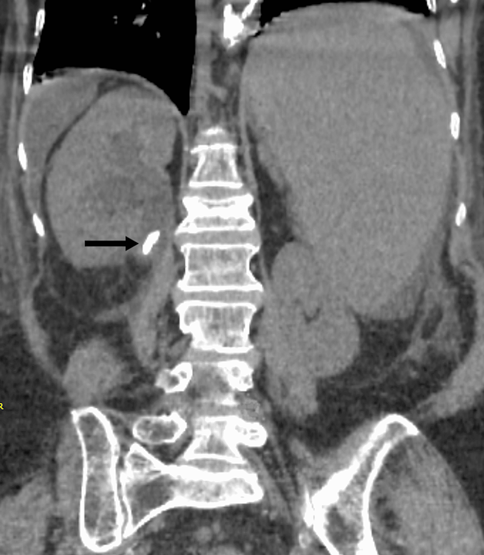 Non-contrast-CT-scan-showing-calcific-calculus-in-right-pelvic-ureteric-junction-measuring-15mm-x-5mm-with-right-hydronephrosis