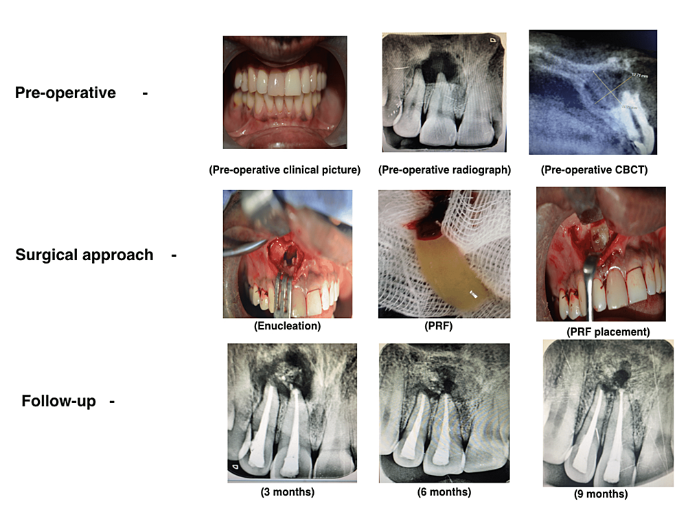 Preoperative,-intraoperative,-and-follow-up-pictures-of-periapical-lesion-management