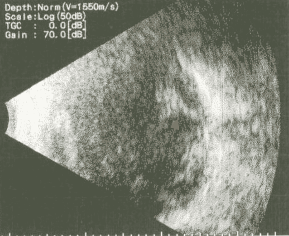 Cureus Optic Nerve Injury, Vitreous Hemorrhage, and Rhegmatogenous