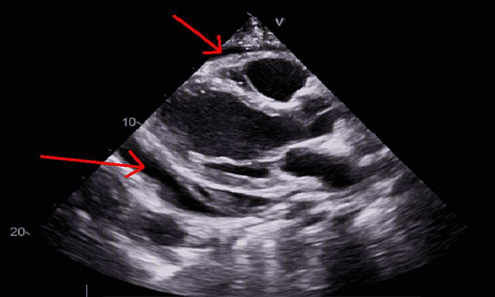 Transthoracic-echocardiogram-on-September-2021.-Red-arrows-point-to-large-pericardial-effusion.