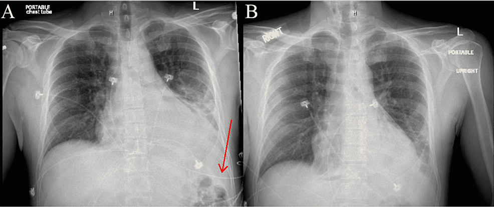 (A)-AP-chest-X-ray-on-September-2021-prior-to-pericardial-window.-Cardiomegaly-is-present-and-red-arrow-points-to-small-left-pleural-effusion.-(B)-AP-chest-X-ray-on-September-2021-after-pericardial-window.-Cardiomegaly-is-improved-and-size-of-cardiac-silhouette-is-reduced.