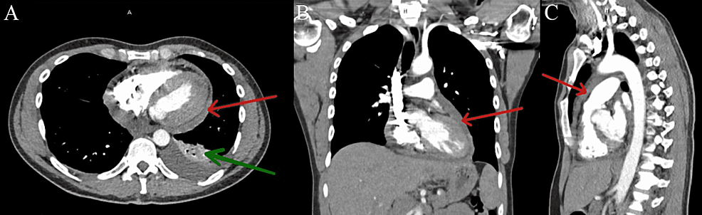 (A)-CT-PE-protocol-transverse-view-of-thorax-on-January-2022.-Red-arrow-shows-small-pericardial-effusion-and-green-arrow-shows-small-left-pleural-effusion.-(B)-CT-PE-protocol-coronal-view-of-thorax-on-January-2022.-Red-arrow-shows-small-pericardial-effusion.-(C)-CT-PE-protocol-sagittal-view-of-thorax-on-January-2022.-Red-arrow-shows-small-pericardial-effusion.