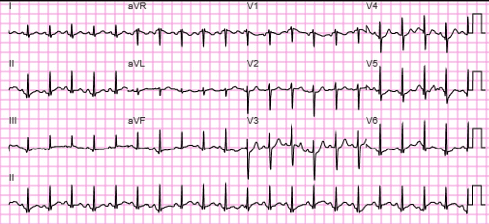 12-lead-EKG-on-January-2022.-Sinus-tachycardia-and-widespread-nonspecific-T-wave-abnormalities.