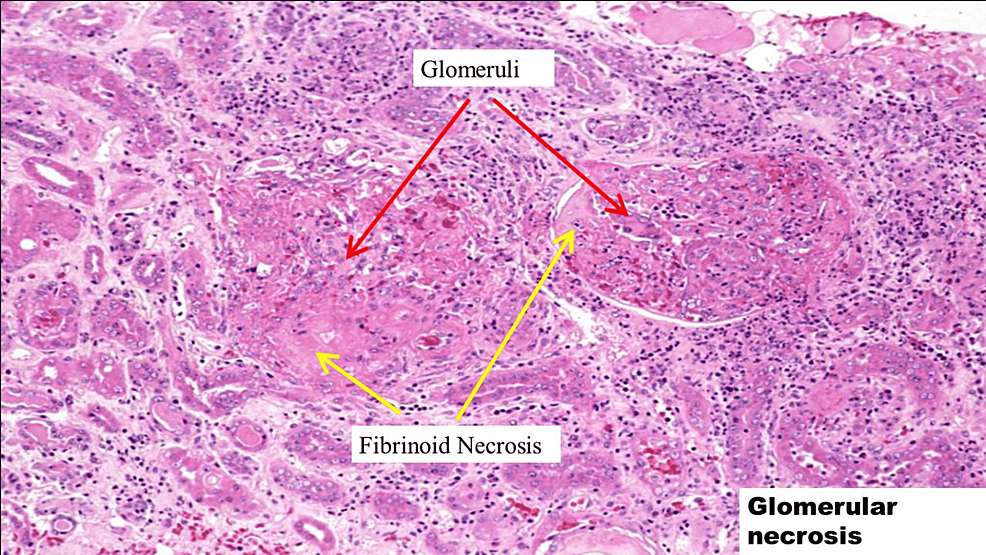 Gram-stain-showing-focal-necrosis-and-diffuse-crescentic-glomerulonephritis.