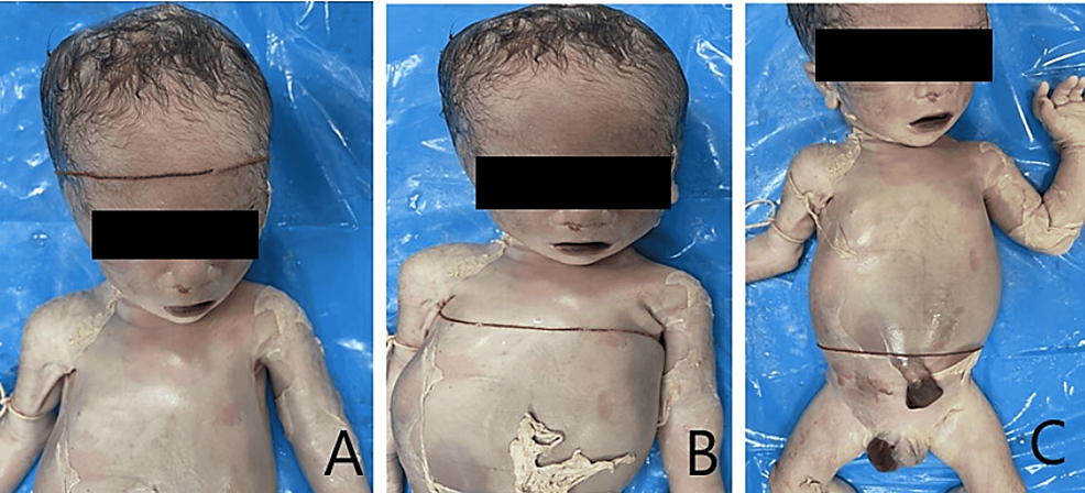 Autopsy Worksheet for Fetus or Infant