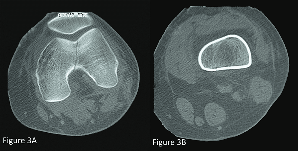 CT-scan-showing-an-intercondylar-fracture-without-cortical-damage-nor-displacement
