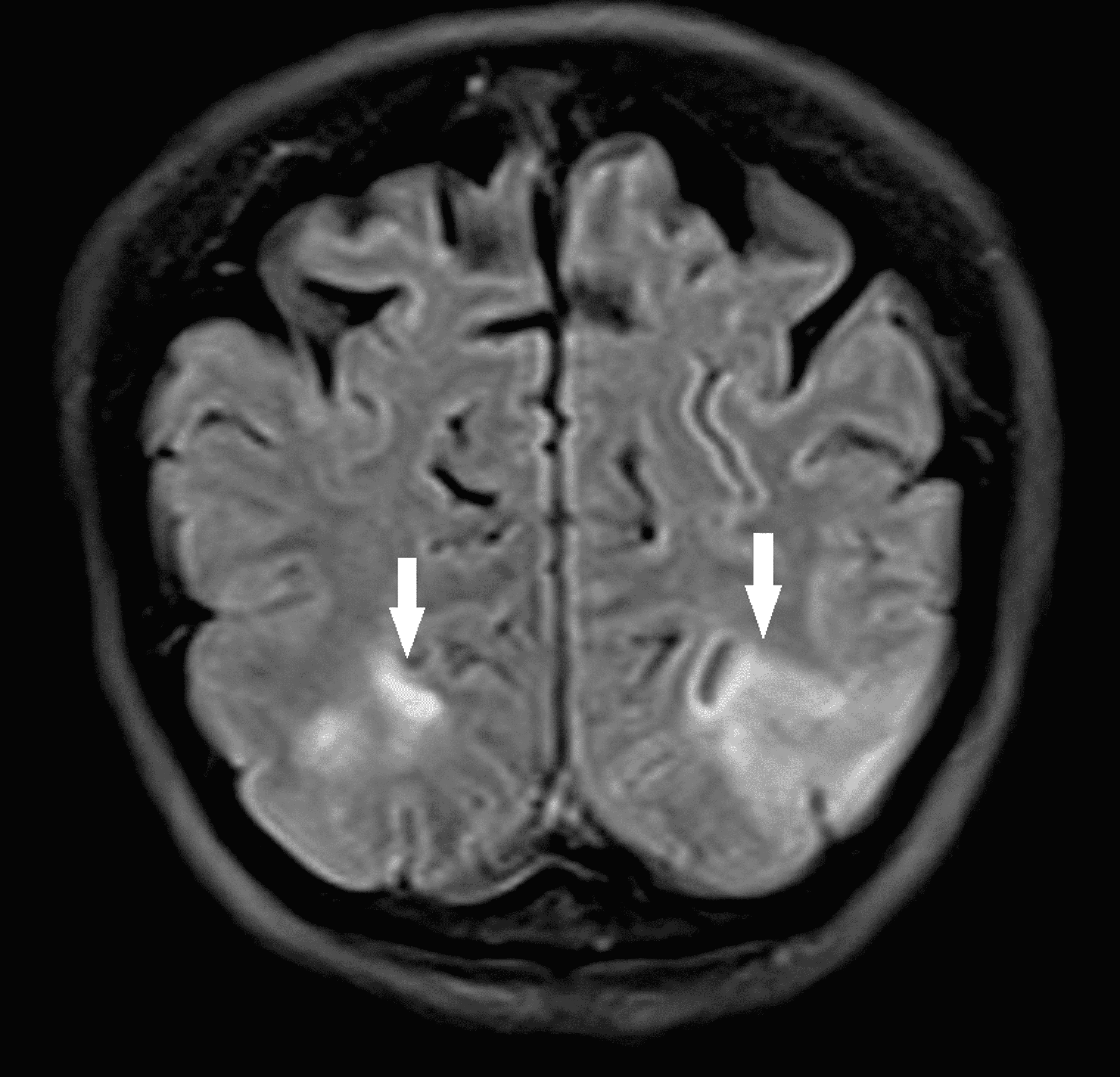 Cureus Posterior Reversible Encephalopathy Syndrome Secondary to R