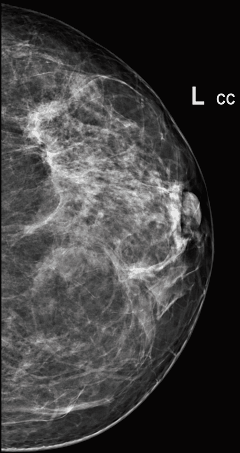 Mammography-shows-a-large-area-of-asymmetrical-density-in-the-left-upper-outer-quadrant