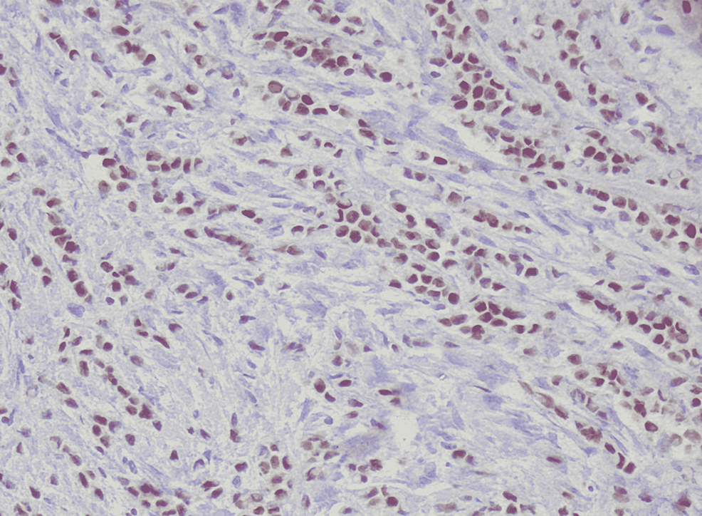 ER-positive-in-60%-cells-(HE-x40)