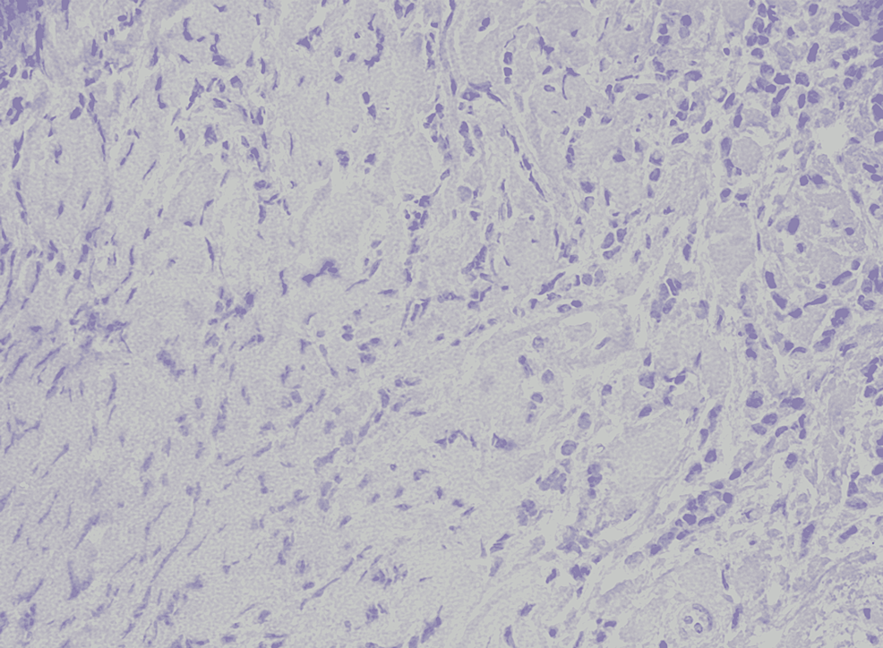 PR-positive-in-5%-of-cells-(HE-x40)