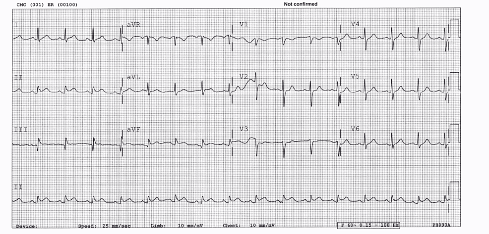 Cureus | Focal Myocarditis As the First Sign in the Presentation of a ...