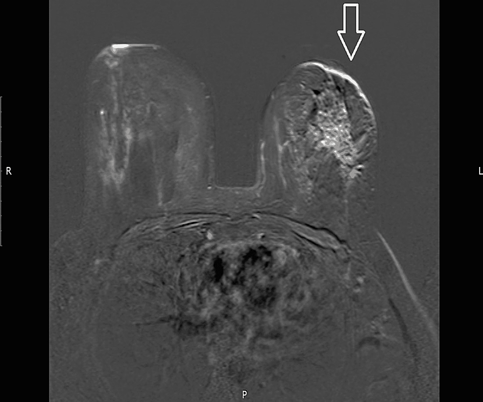 Magnetic-resonance-imaging-shows-left-breast-showed-4.2-x-3.3cm-heterogeneously-enhancing-asymmetric-mass-like-enhancement-area-within-the-left-breast-outer-quadrant-with-adjacent-another-spiculated-nodular-lesion-measuring-2.2cm