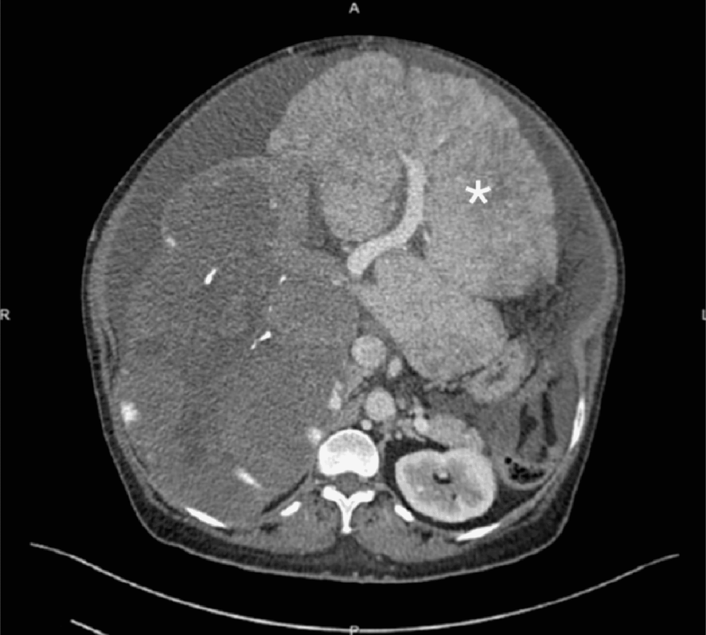 Cureus A Giant Hepatic Hemangioma Presenting With Bilateral Pulmonary