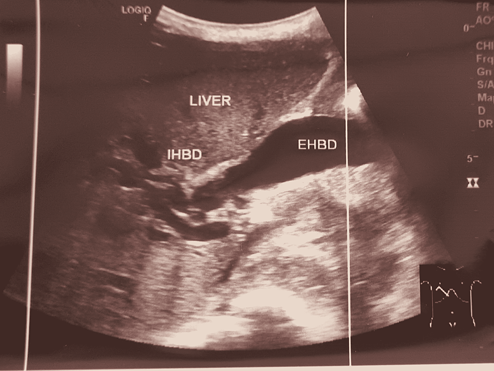 Dilated-IHBD-and-EHBD-on-abdominal-USG.