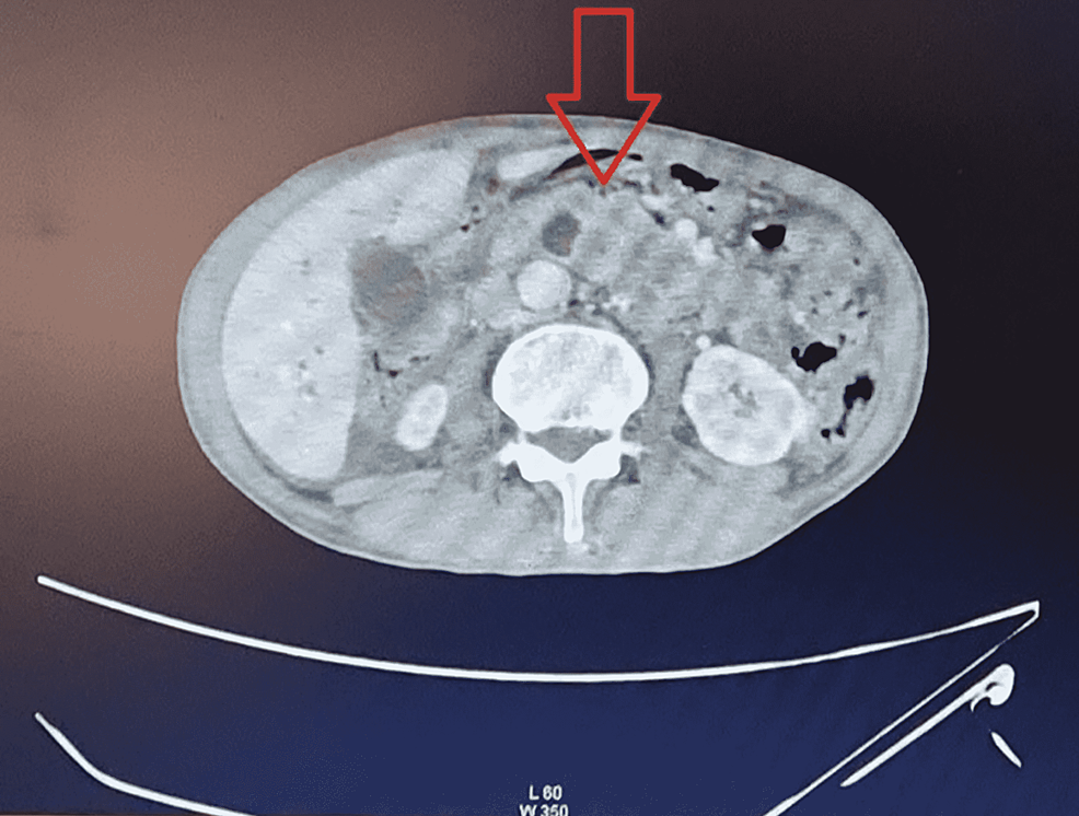 Mass-on-the-pancreatic-head-in-contrast-enhanced-abdominal-CT-scan.