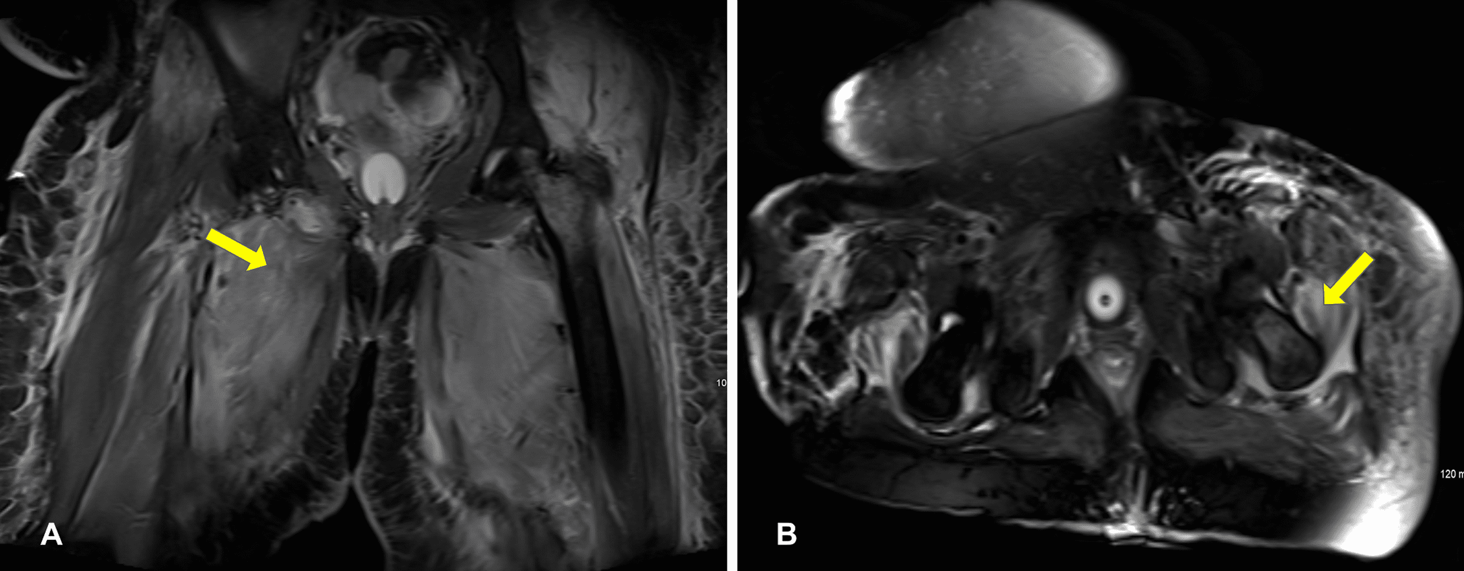 Cureus | Severe Rhabdomyolysis Complicated With Acute Kidney Injury  Required Renal Replacement Therapy After Pfizer COVID-19 Vaccine