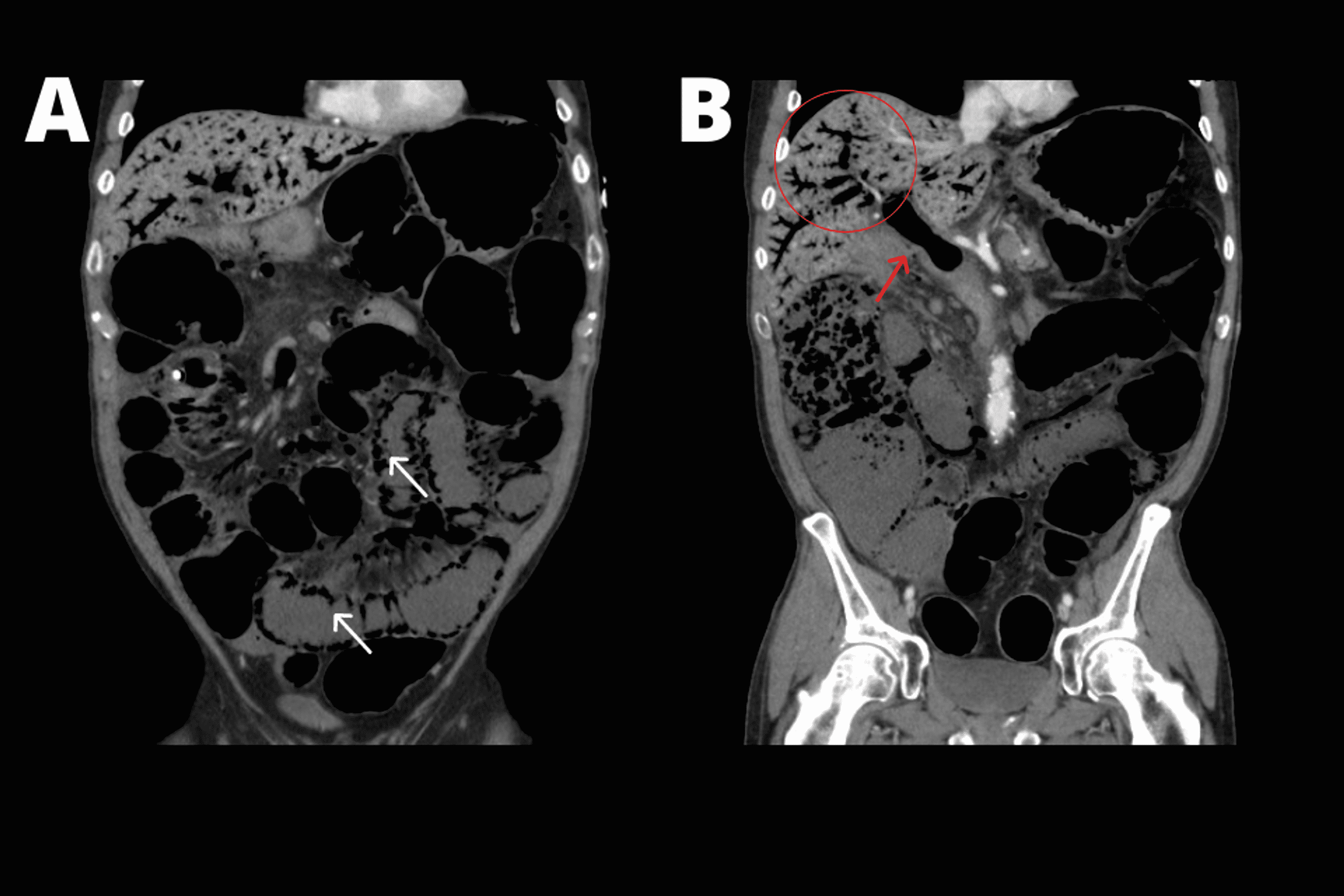 Cureus Tube FeedingRelated Bowel Ischemia Presenting As Extensive