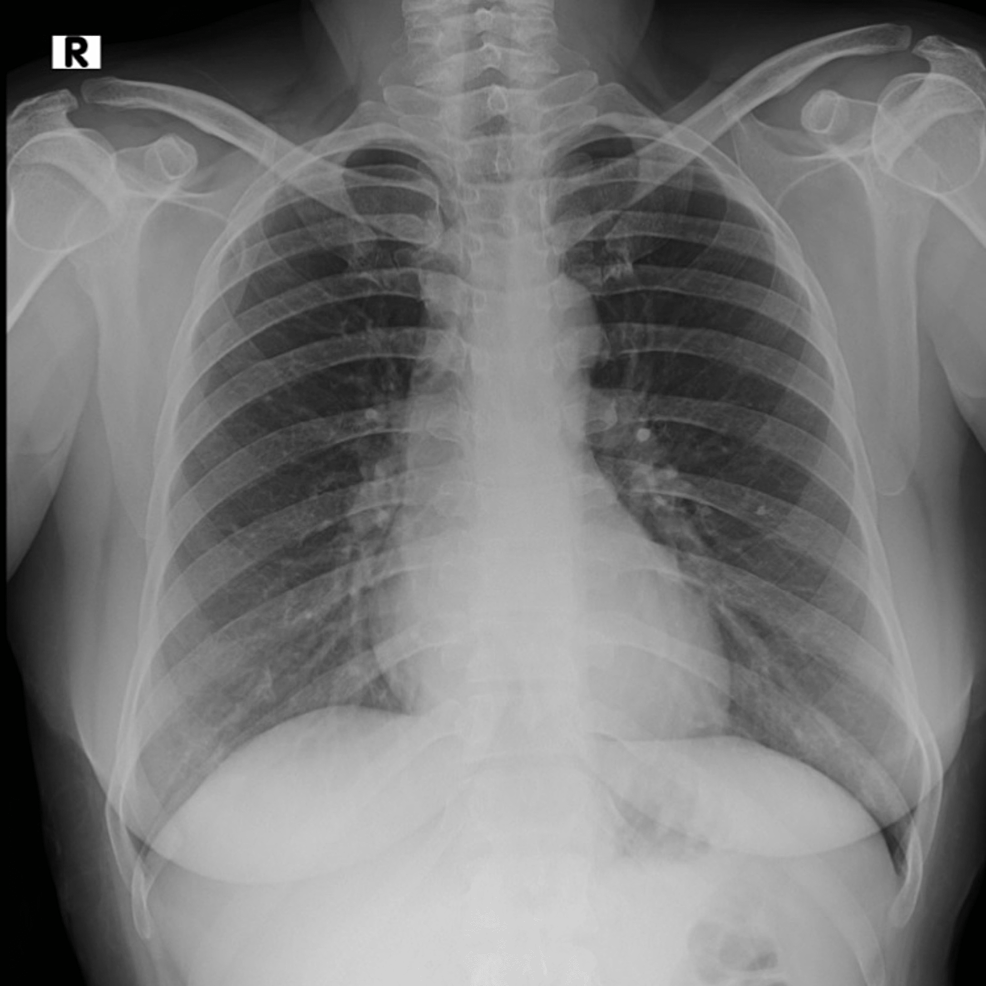 Cureus | Tracheal Duplication Cyst Presenting as Chest Pain