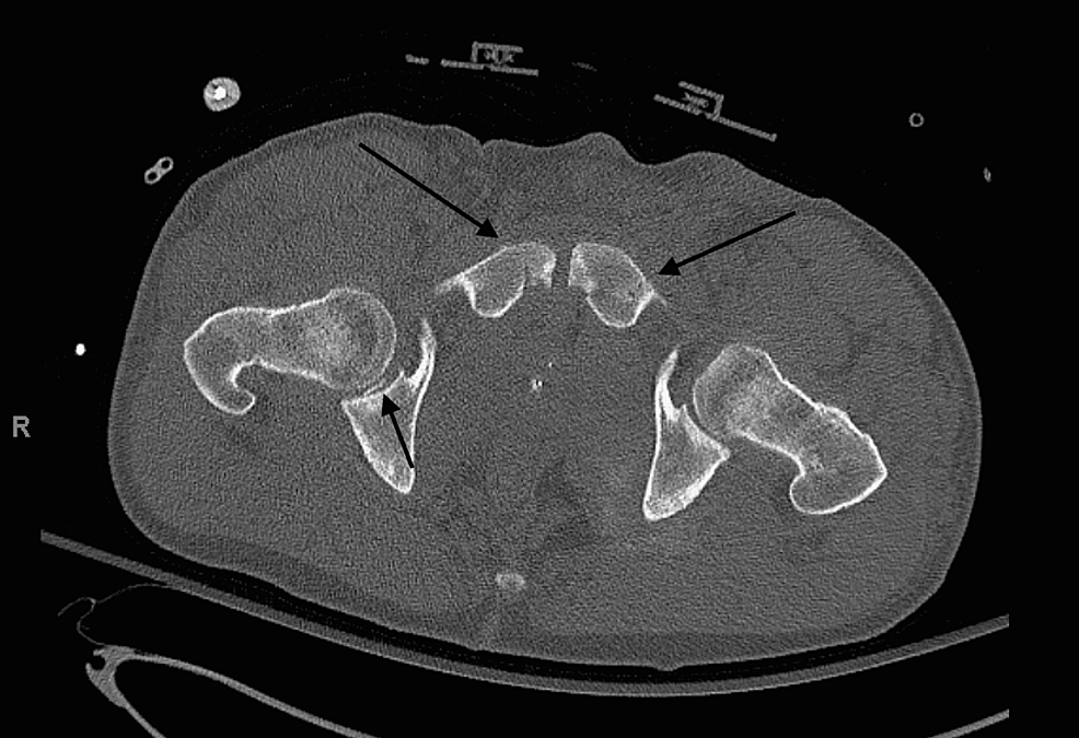 Cureus | Asymmetric Bilateral Hip Dislocations With An Associated ...