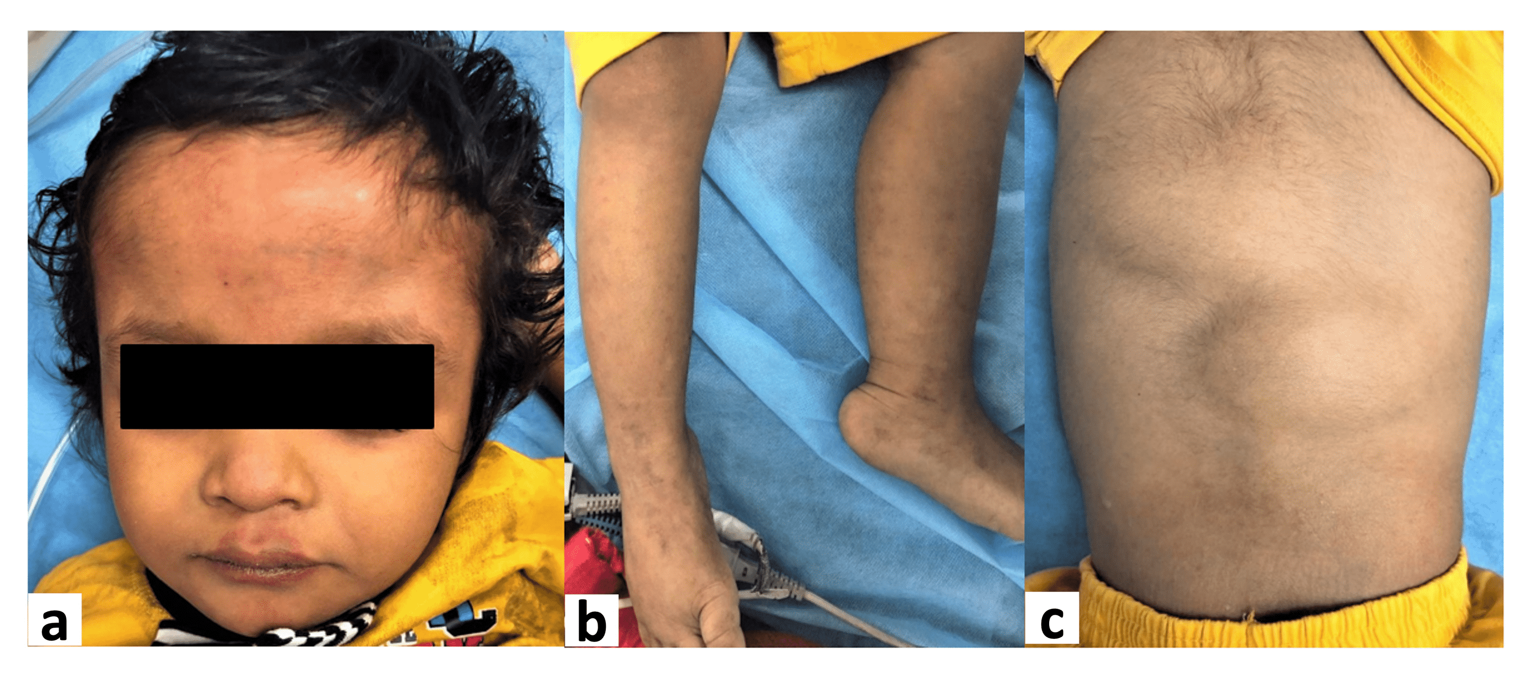 Cureus Megalencephaly Capillary Malformation Polymicrogyria Syndrome Mcap A Rare Dynamic Genetic Disorder