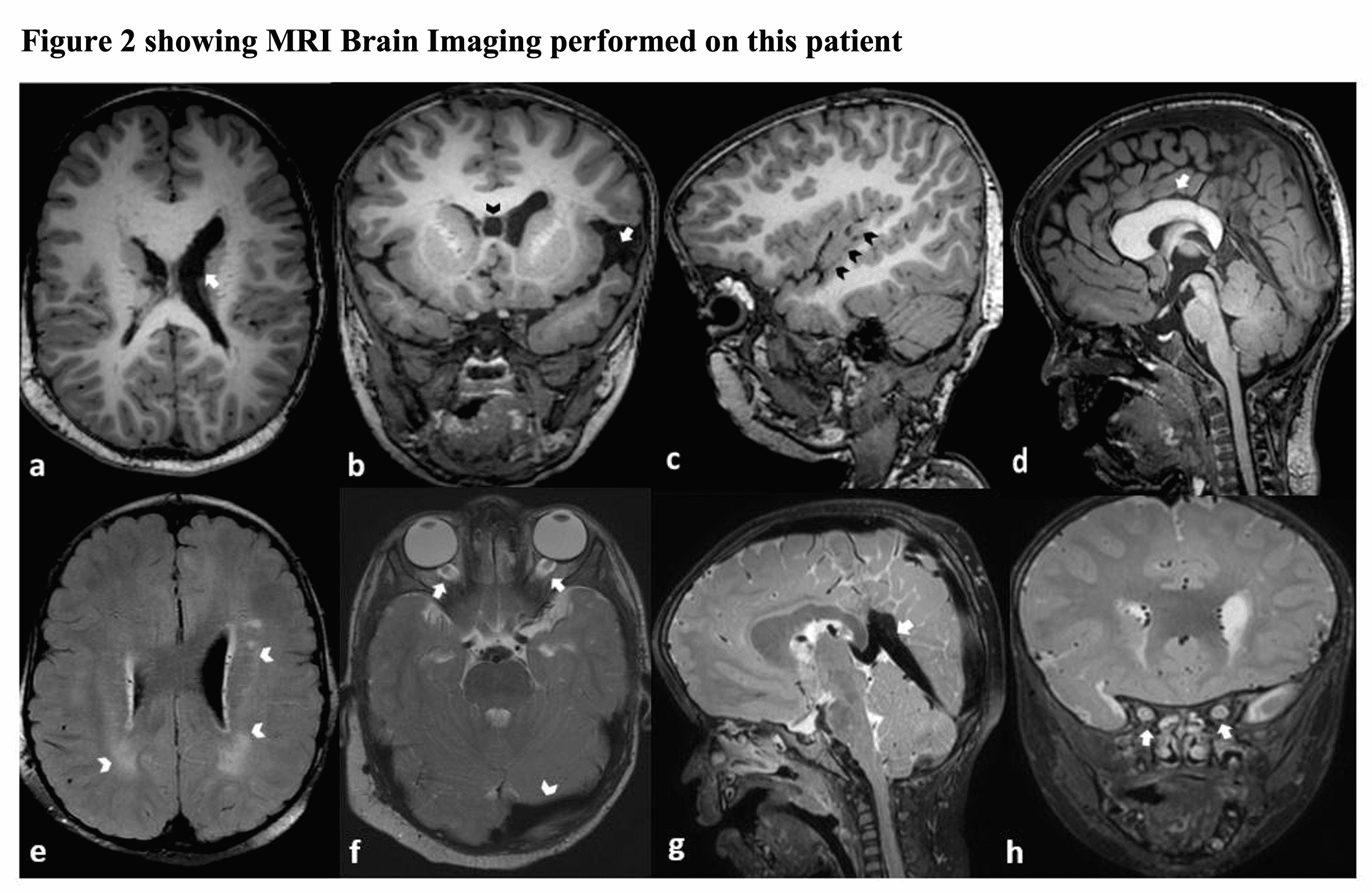 Cureus Megalencephaly Capillary Malformation Polymicrogyria Syndrome Mcap A Rare Dynamic Genetic Disorder