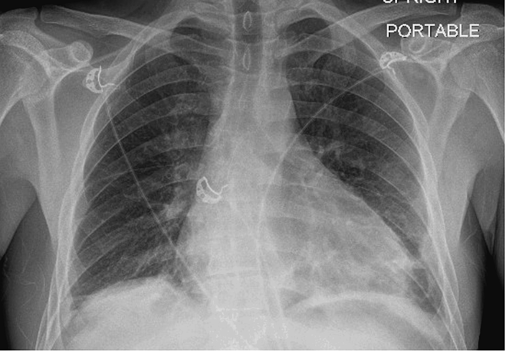 Portable-anteroposterior-erect-film-demonstrating-new-subsegmental-atelectasis-at-right-lung-base-+-infiltrates-and-atelectasis-within-the-left-lower-lobe-and-inferior-segment-of-the-lingula.