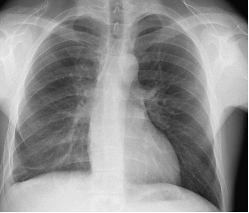 Chest-X-ray-taken-three-weeks-after-the-previous-film-demonstrating-resolution-of-infiltrates-previously-present-on-the-left-lung-and-new-mild-infiltrates-in-the-right-middle-lobe.