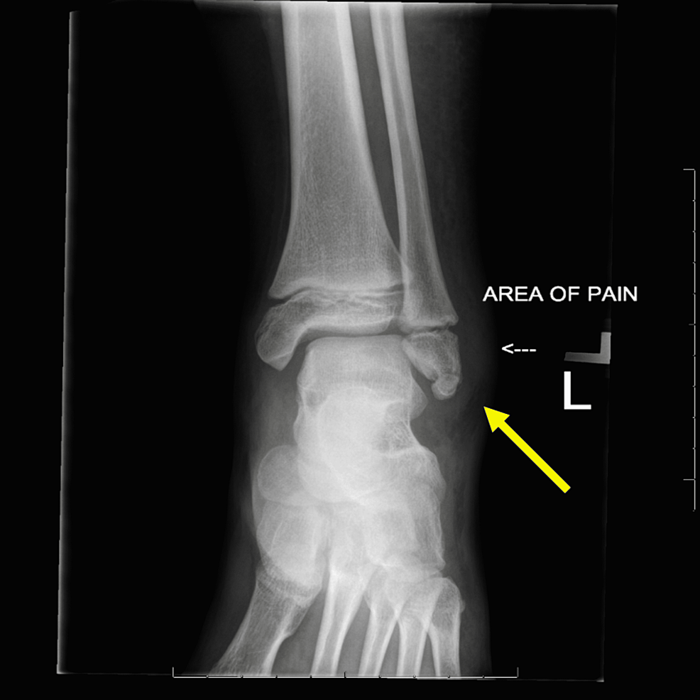 Cross compression view of the ACOM, Radiology Case