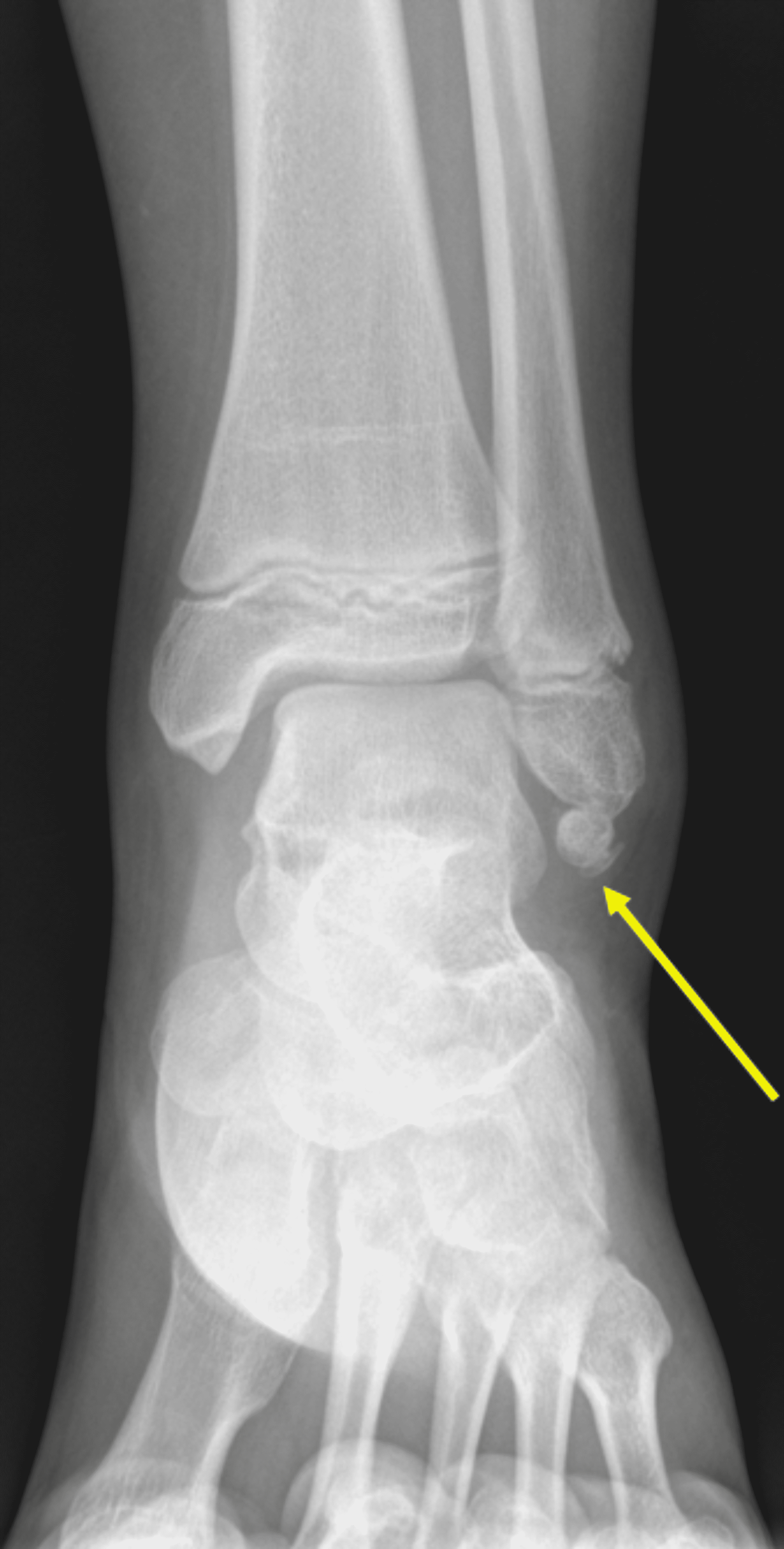 Cureus Optimal Visualization of Os Subfibulare Using 3D Water