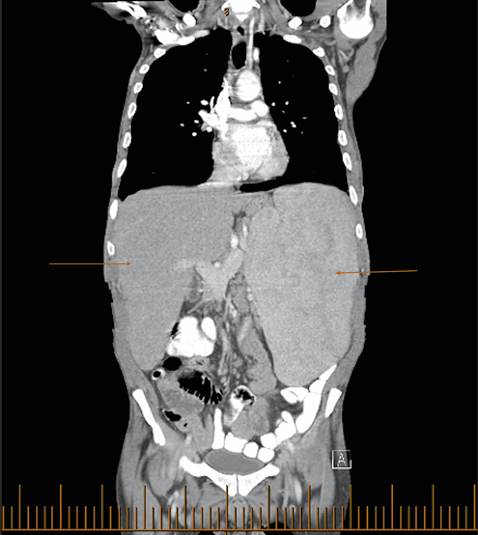 CT-abdomen-and-pelvis-without-contrast-revealing-hepatosplenomegaly