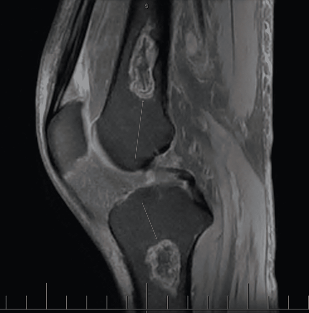 MRI-of-the-left-knee-with-and-without-contrast-revealing-bony-involvement