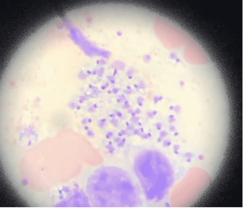 Histopathology-with-Giemsa-staining,-100x-magnification,-showing-small-organisms-with-morphology-suggestive-of-Trypanosomatidae,-specifically-Leishmania-species-both-inside-white-cells-and-in-extracellular-space
