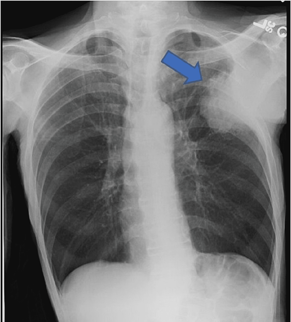 CXR-showing-left-chest-wall-mass-(arrow),-with-erosions-of-the-third-and-fourth-ribs.-The-mass-measures-at-least-7-×-8.5-cm-in-size-as-it-projects-into-the-left-lung.-The-right-lung-remains-clear.-The-cardiac-and-mediastinal-contours-appear-normal.
