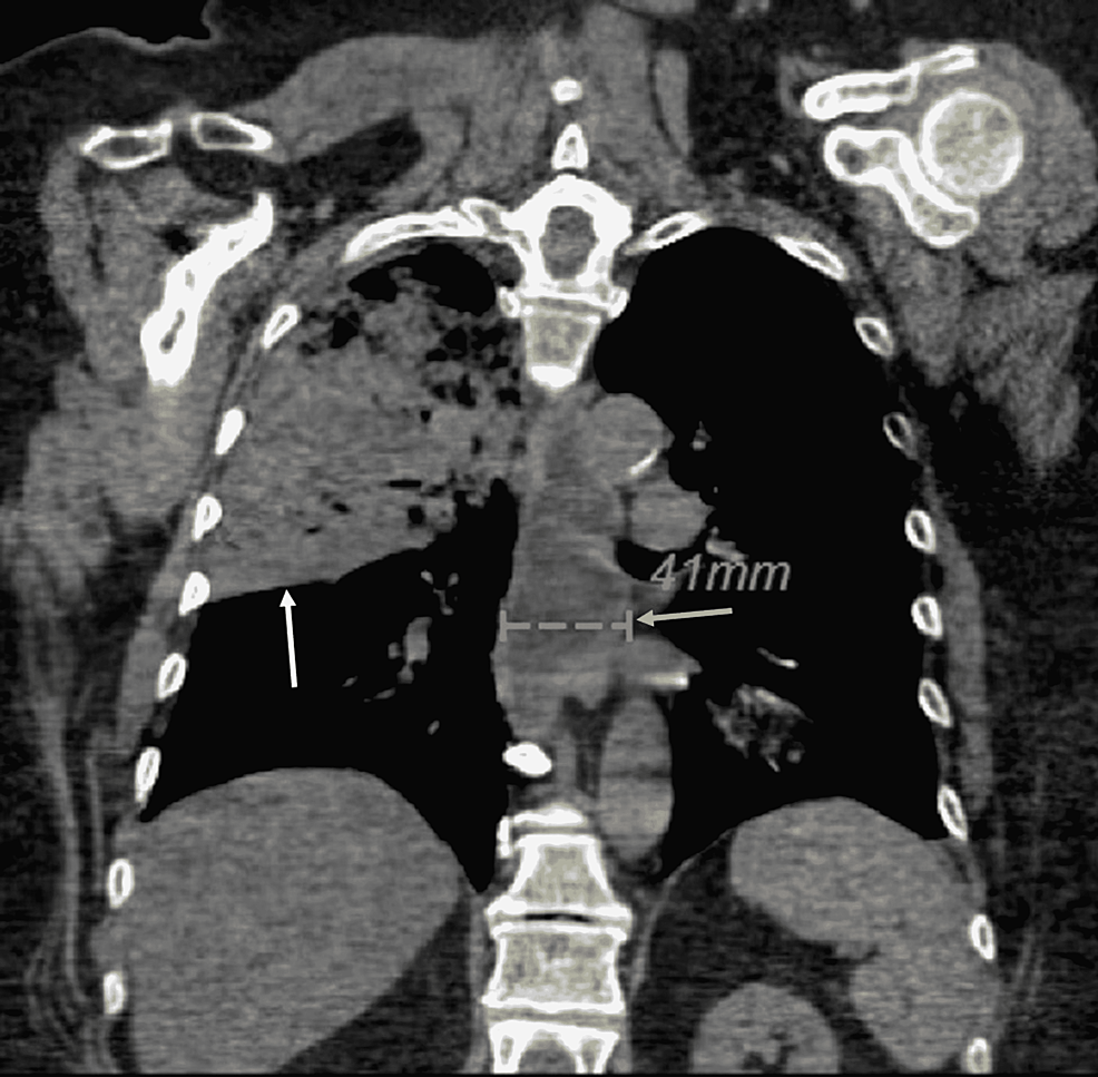 Aspiration pneumonia, Radiology Reference Article