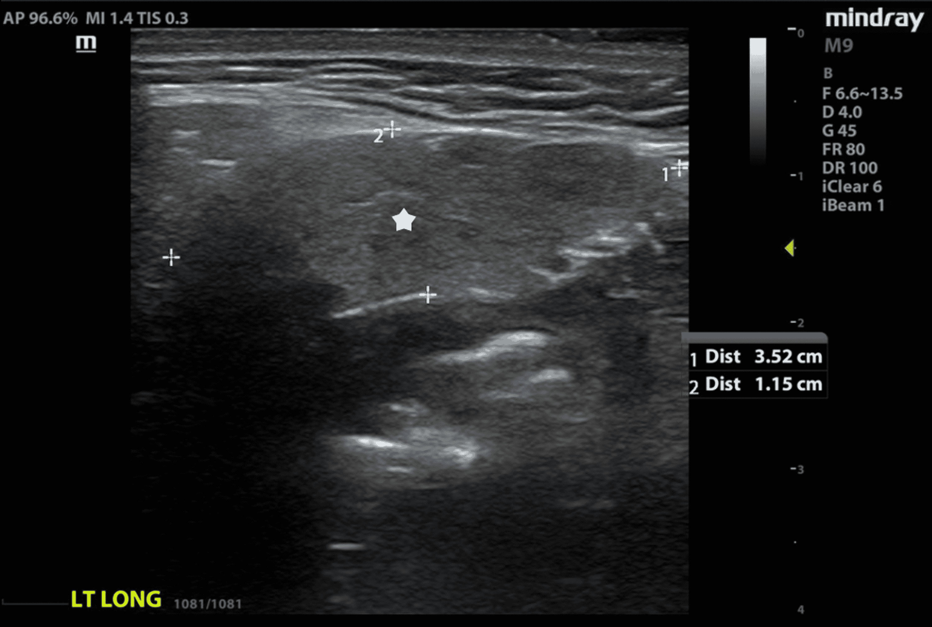 Cureus Utility Of Point Of Care Ultrasound For The Rapid Evaluation