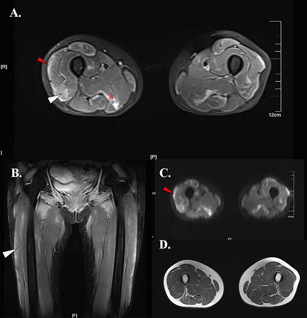 Cureus Thigh Muscle MRI Edema Features of Dermatomyositis Patients