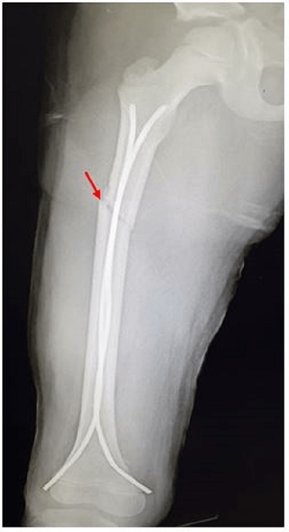 8 months walking after broken femur or thigh bone #brokenbone #bone  #brokenleg #femur #rod - YouTube