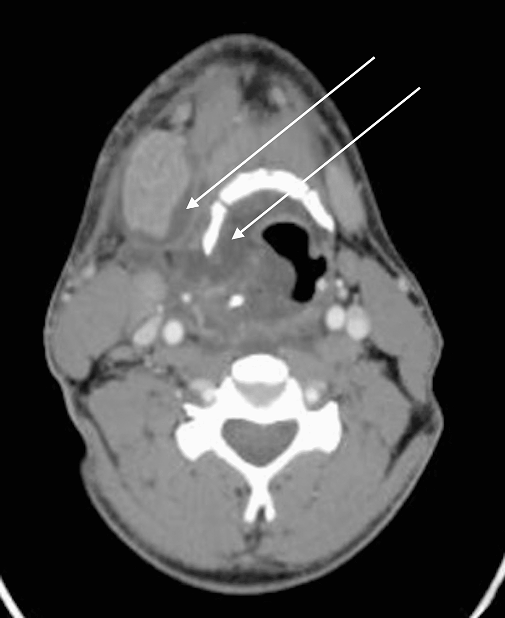 Axial-view-of-CT-scan-at-initial-presentation