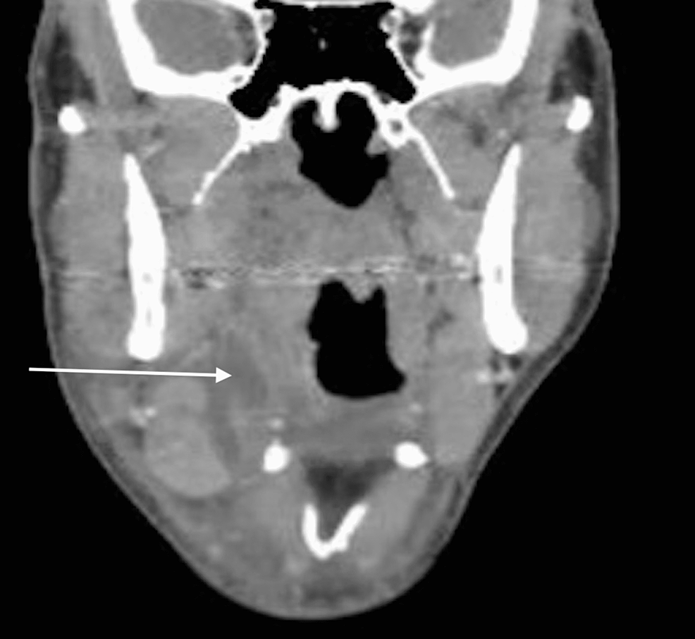Coronal-view-of-CT-scan-at-initial-presentation