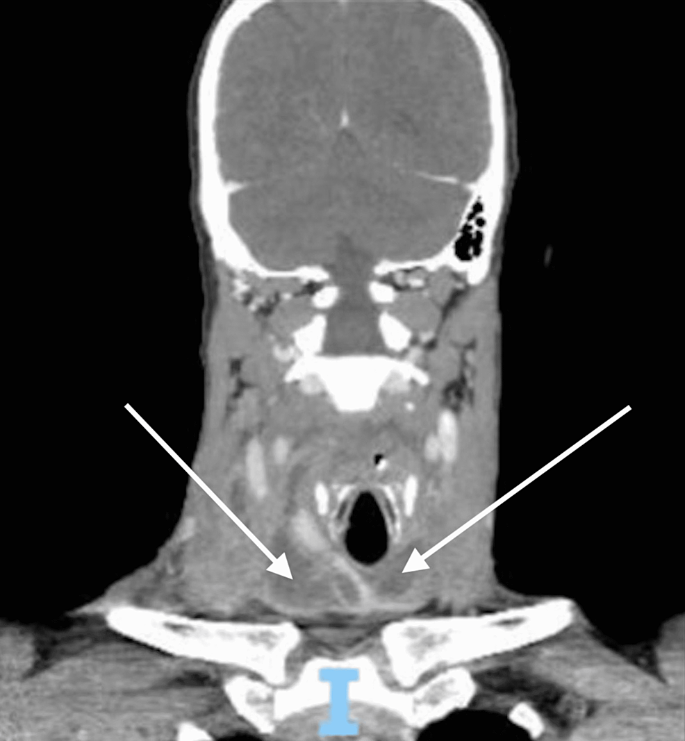 Coronal-view-of-the-CT-scan-on-hospital-day-5