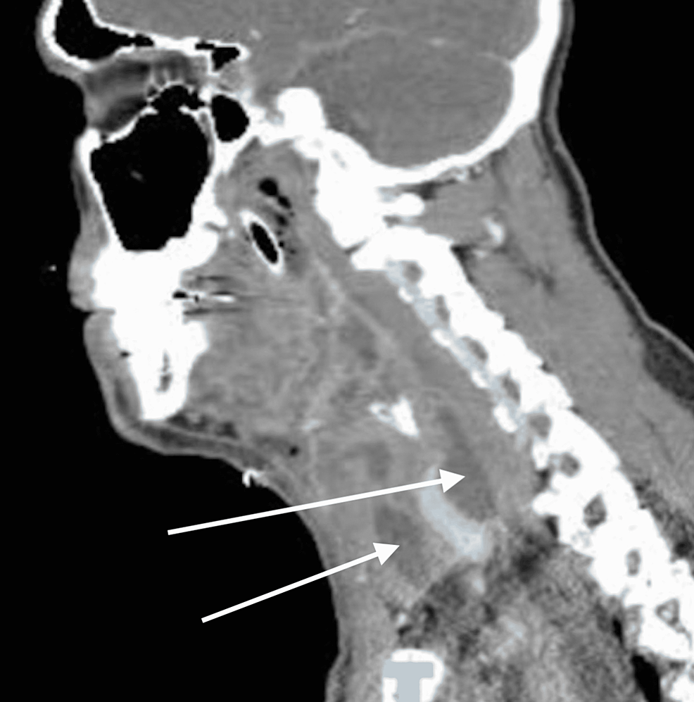 Sagittal-view-of-the-CT-scan-on-hospital-day-5
