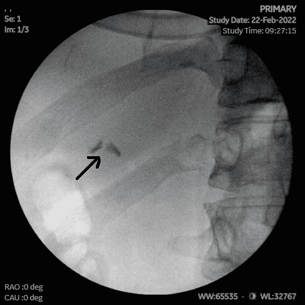 Intraoperative-fluoroscopy-showing-surgical-clips-in-the-right-upper-quadrant-of-the-abdomen.