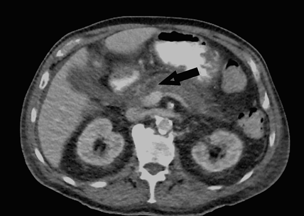 A Rare Case of Pancreatic Cancer: Undifferentiated Carcinoma of the ...