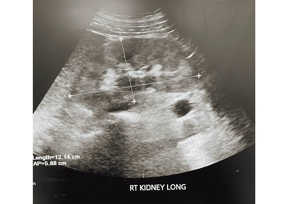 Ultrasound-of-right-kidney-showing-diffuse-increased-echogenicity-of-renal-parenchyma-consistent-with-chronic-renal-disease.