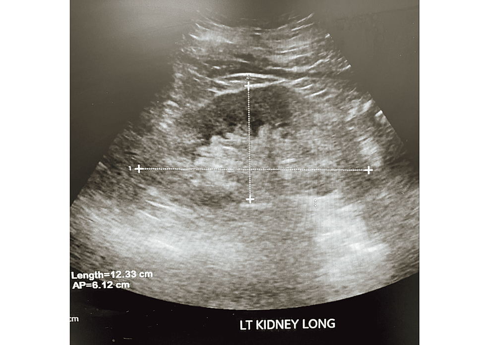 Ultrasound-of-left-kidney-showing-diffuse-increased-echogenicity-of-renal-parenchyma-consistent-with-chronic-renal-disease.-