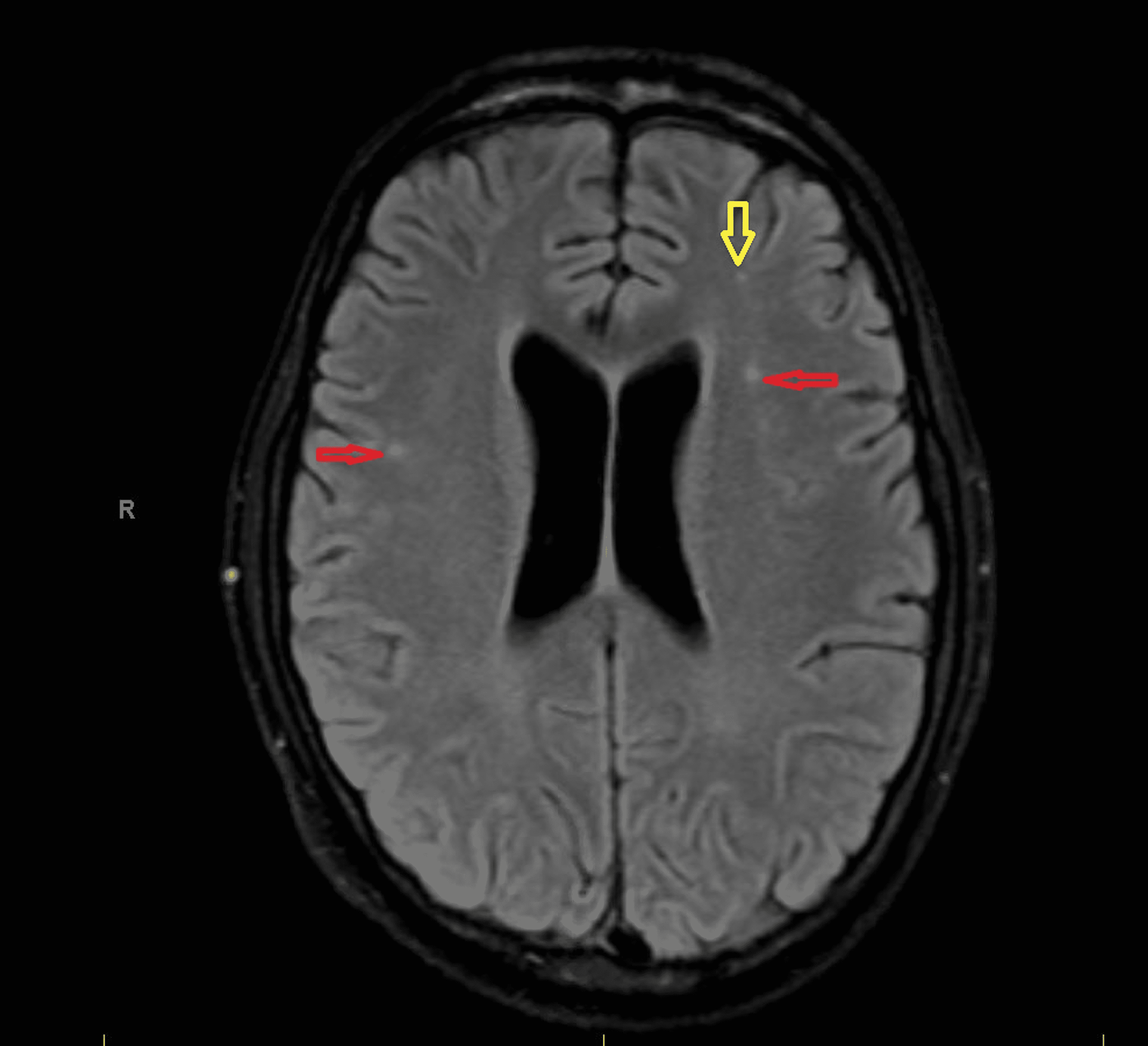 Cureus | Enterovirus-Induced Severe Rhabdomyolysis and Acute Fulminant ...